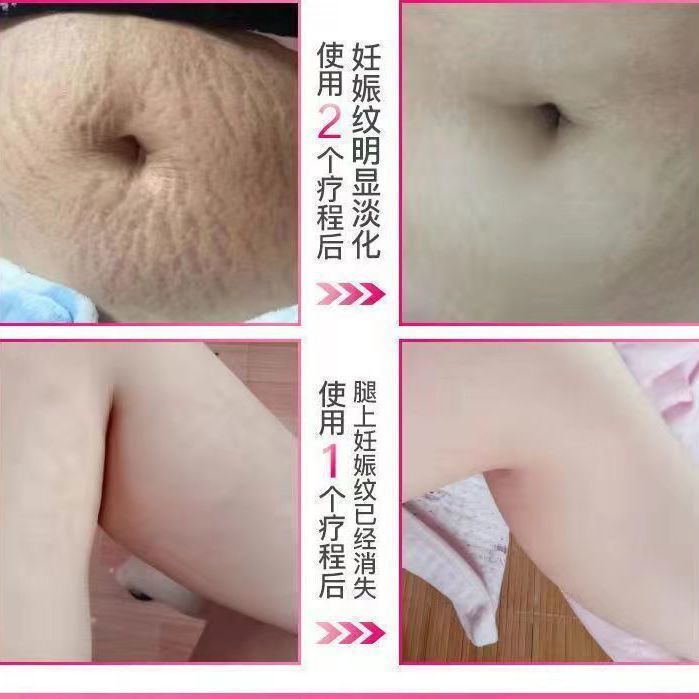 少妇去妊娠纹产后修复霜精油套装 孕妇专用淡化消除预防紧致肚皮祛肥胖纹生长纹 产后修复舒缓油祛妊娠纹
