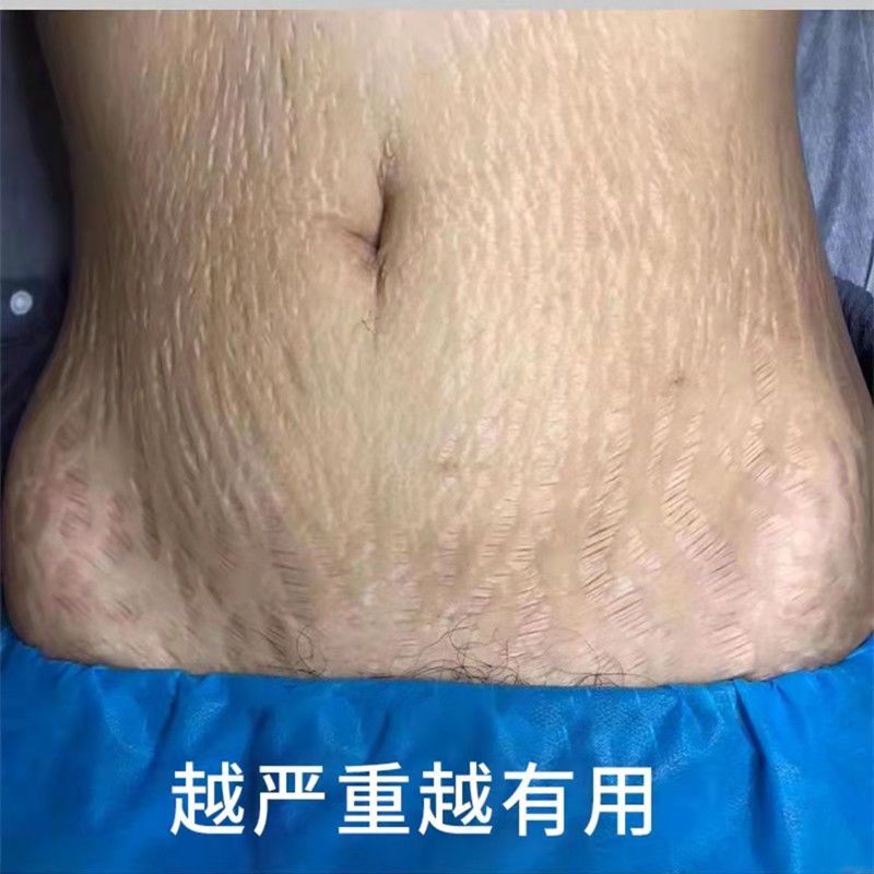 少妇去妊娠纹产后修复霜精油套装 孕妇专用淡化消除预防紧致肚皮祛肥胖纹生长纹 产后修复舒缓油祛妊娠纹