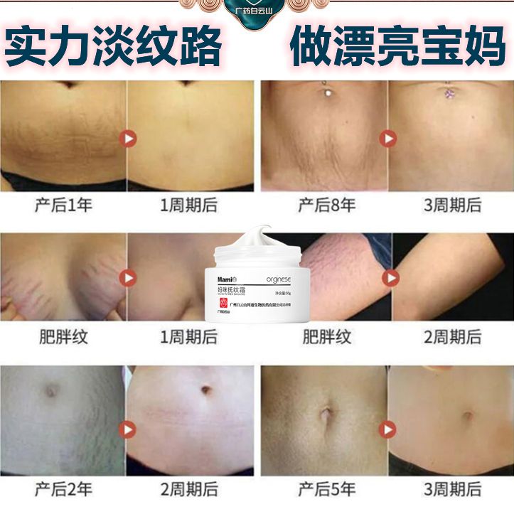 广药白云山去妊娠纹产后修复霜淡化紧致肚皮预防橄榄油 大腿纹怀孕期孕妇专用消除生长纹肥胖纹