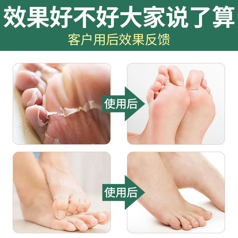 脚汗脚臭粉泡脚中药包去真菌止汗脚除臭脚克星 瑶辰足爽王抑菌足浴粉脚痒水泡脱皮烂脚丫