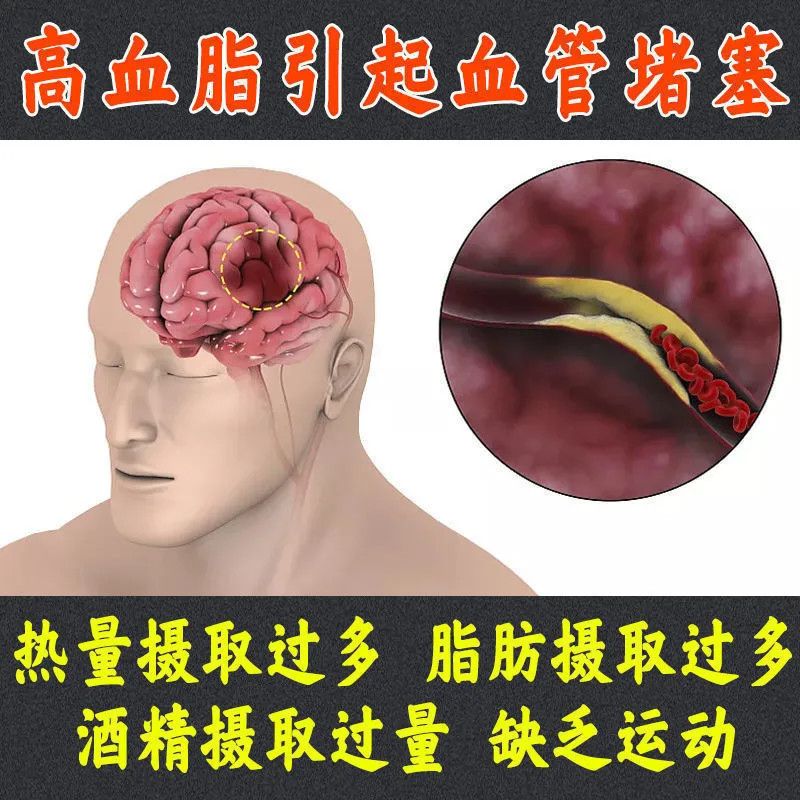 降血脂药血液粘稠胆固醇高100片装 清血管降血脂甘油三酯心悸气短胸闷肢麻 高血脂手麻头晕头痛耳鸣血瘀
